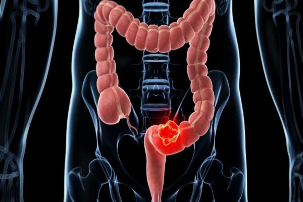 Cáncer de colon