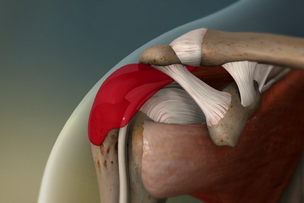 ¿Qué es la bursitis?