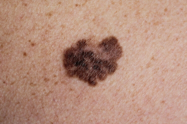 Melanoma