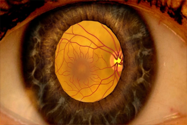 ¿Qué es un edema macular?