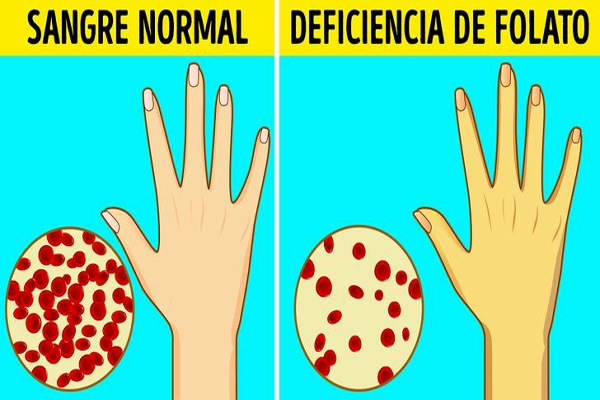 Deficiencia de ácido fólico